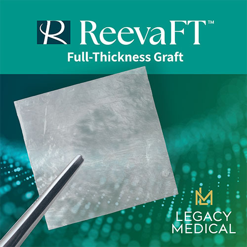 Legacy Medical Consultants Announces Addition of Reeva FT™ Allograft
